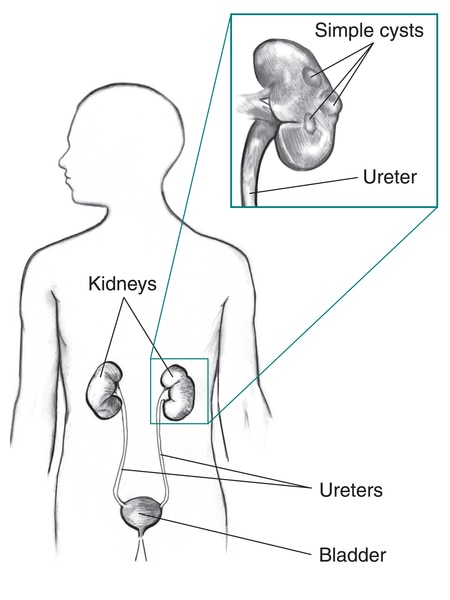 Drawing of the urinary tract in the outline of a male figure and inset image of simple kidney cysts.