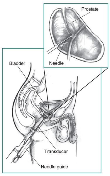 Drawing of a transrectal ultrasound with prostate biopsy, showing a needle and needle guide inserted in the rectum. The bladder, transducer, and needle guide are labeled. Inset of enlarged view of prostate with needle inserted. The prostate and needle are