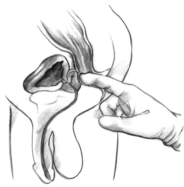 Cross-section diagram of a digital rectal exam. A health care provider's gloved index finger inserted into the rectum to feel the size and shape of the prostate.