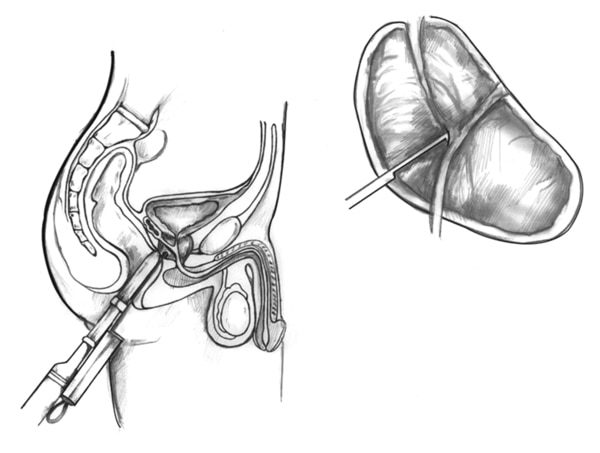 Drawing of a transrectal ultrasound with prostate biopsy, showing a needle and needle guide inserted in the rectum. The bladder, transducer, and needle guide are labeled. Inset of enlarged view of prostate with needle inserted.