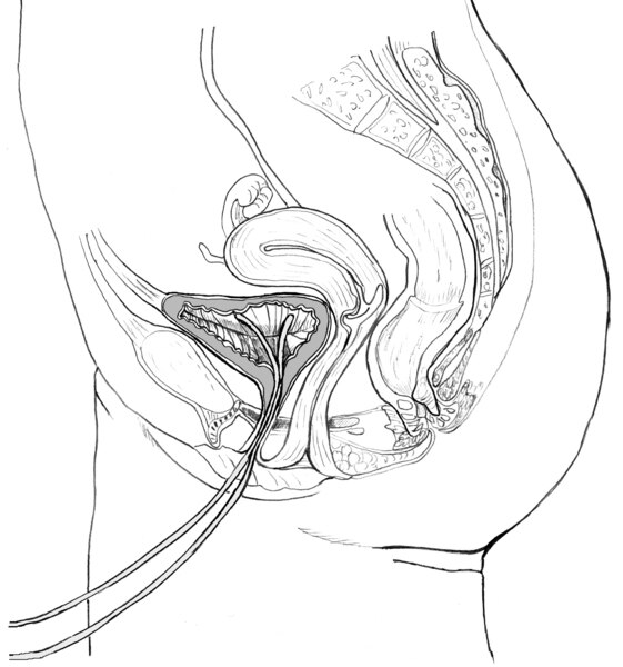 Drawing of the side view of the male urinary tract with a catheter inserted through the urethra to the bladder.