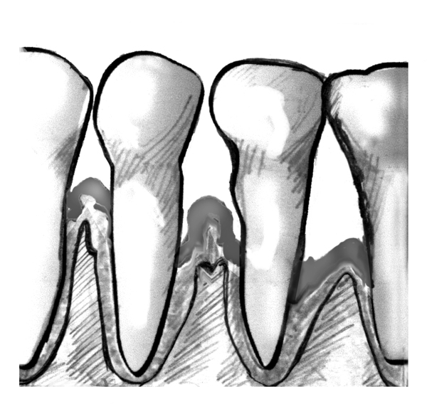 Drawing of a close-up view of teeth and gums with periodontitis.