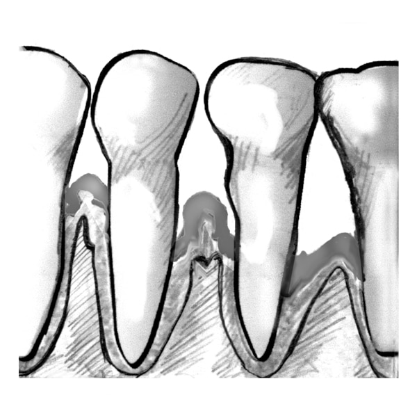 Drawing of a close-up view of teeth and gums with periodontitis.
