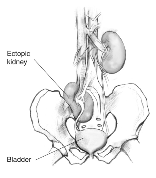 Drawing of a pelvic ectopic kidney labeled, showing the pelvis, bladder, ureters, and kidneys. The kidney on the right is in the normal position, several inches above the bladder. The kidney on the left is an ectopic kidney, just a couple of inches above