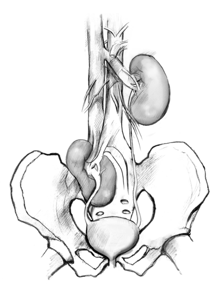 Drawing of a pelvic ectopic kidney, showing the pelvis, bladder, ureters, and kidneys. The kidney on the right is in the normal position, several inches above the bladder. The kidney on the left is an ectopic kidney, just a couple of inches above the blad