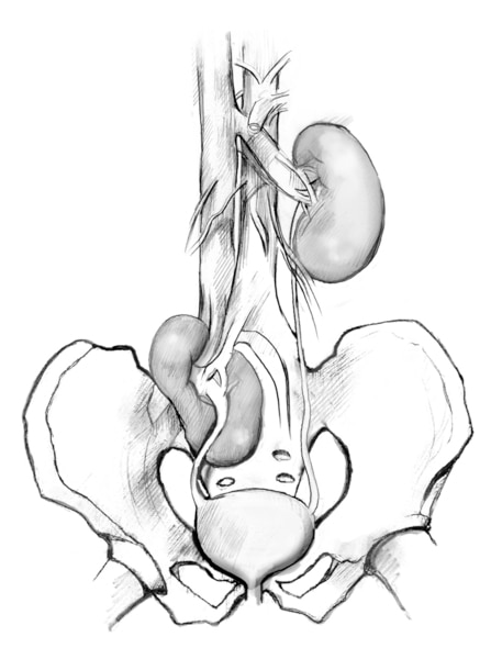 Drawing of a pelvic ectopic kidney, showing the pelvis, bladder, ureters, and kidneys. The kidney on the right is in the normal position, several inches above the bladder. The kidney on the left is an ectopic kidney, just a couple of inches above the blad