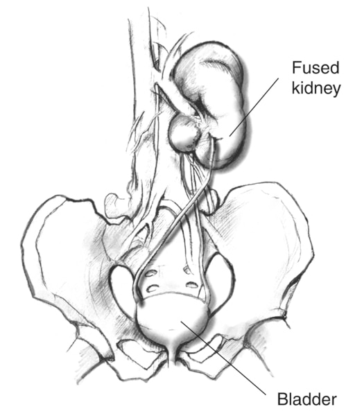 Drawing of a fused ectopic kidney, showing the pelvis, bladder, ureters, and fused kidneys. The kidney that would normally be on the left has crossed over and fused with the kidney on the right.