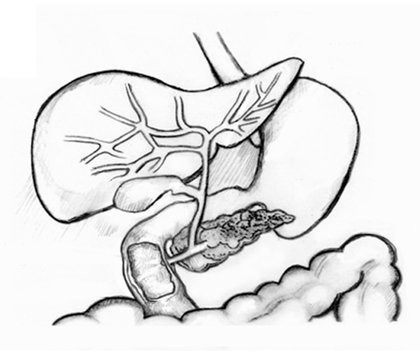 Drawing of the biliary system with the liver, biliary tree (bile ducts), common bile duct, gallbladder, pancreas, duodenal papilla, main pancreatic duct, and duodenum