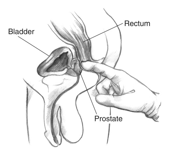 Cross section of a digital rectal exam. A health care provider’s gloved index finger is inserted into the rectum to feel the size and shape of the prostate.