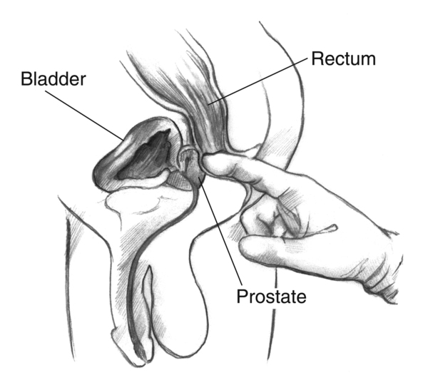 Cross section of a digital rectal exam. A health care provider’s gloved index finger is inserted into the rectum to feel the size and shape of the prostate.