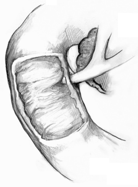 Enlarged biliary system with the duodenal papilla and papillary orifice.