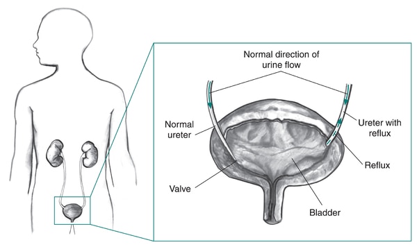 Drawing of the urinary tract in the outline of a male figure with an inset of a cross section of the bladder. The cross-section image has arrows and labels that show the normal direction of urine flow in a normal ureter and reflux in a shortened ureter. O