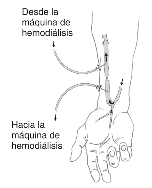Una ilustración de un antebrazo con una fístula arteriovenosa. Las flechas muestran la dirección del flujo de sangre. Dos agujas se introducen en la fístula. Las etiquetas explican que una aguja lleva la sangre hacia la máquina del dializador. La otra reg