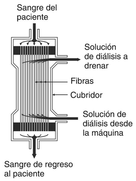 Una imagen de un diagrama de un dializador hueco de fibra. Sección transversal de una estructura de un dializador típico hueco de fibra. Se identifica el área donde entra la sangre del paciente, la solución de diálisis a drenarse, las fibras, el cubridor,