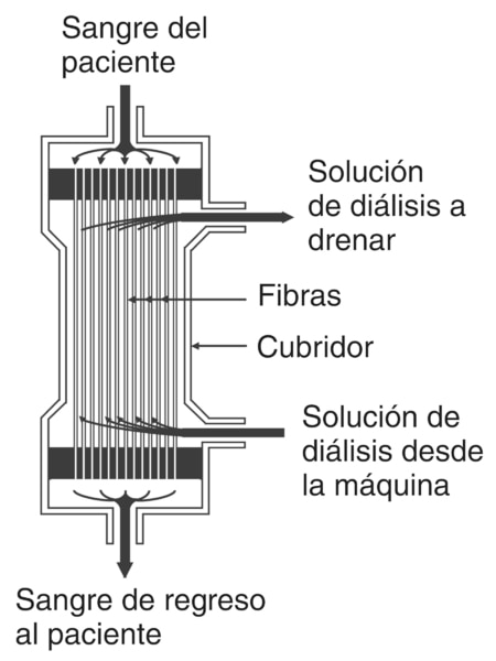 Una imagen de un diagrama de un dializador hueco de fibra. Sección transversal de una estructura de un dializador típico hueco de fibra. Se identifica el área donde entra la sangre del paciente, la solución de diálisis a drenarse, las fibras, el cubridor,