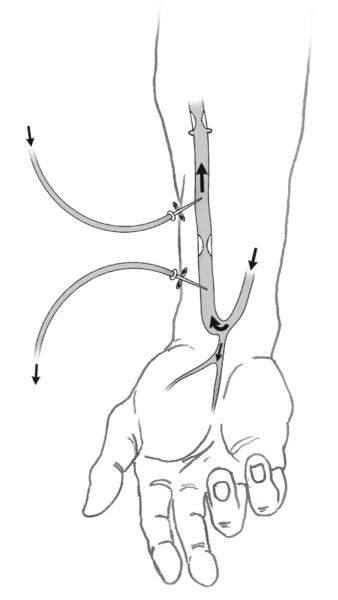 Una ilustración de un antebrazo con una fístula arteriovenosa. Las flechas muestran la dirección del flujo de sangre. Dos agujas se introducen en la fístula. Las etiquetas explican que una aguja lleva la sangre hacia la máquina del dializador. La otra reg
