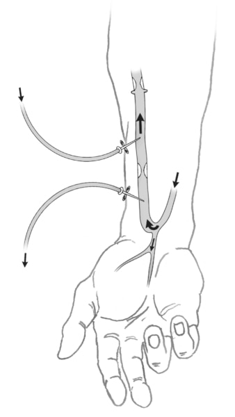 Una ilustración de un antebrazo con una fístula arteriovenosa. Las flechas muestran la dirección del flujo de sangre. Dos agujas se introducen en la fístula. Las etiquetas explican que una aguja lleva la sangre hacia la máquina del dializador. La otra reg