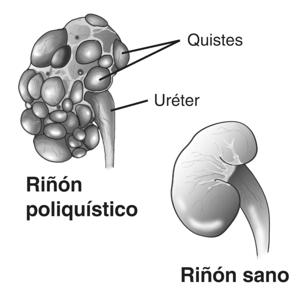 Ilustración de un riñón sano y un riñón poliquístico. El riñón sano en la parte inferior derecha es liso. El riñón poliquístico en la parte superior izquierda tiene muchas bolsas llenas de líquido, llamados quistes, en la superficie. Se identifica en el r