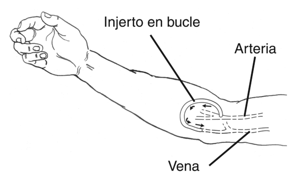 Ilustración de un brazo con un injerto arteriovenoso. El injerto, identificado como “injerto en bucle”, se conecta con la arteria hacia la vena. Las flechas señalan la dirección del flujo de sangre desde la arteria, a través del injerto, a la vena.