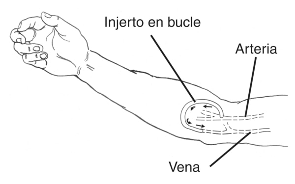 Ilustración de un brazo con un injerto arteriovenoso. El injerto, identificado como “injerto en bucle”, se conecta con la arteria hacia la vena. Las flechas señalan la dirección del flujo de sangre desde la arteria, a través del injerto, a la vena.