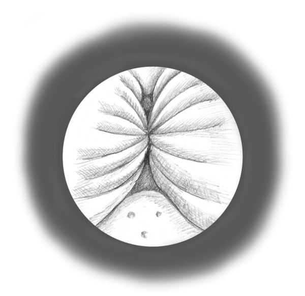 Ilustración del interior de la uretra, vista a través de un cistoscopio. Las paredes de la uretra están cerradas entre sí, dejando poco espacio para que la orina fluya.
