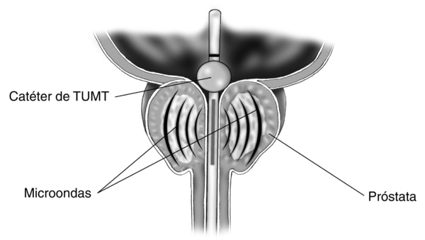 Ilustración de la sección transversal de la próstata, vejiga y uretra. Un catéter para termoterapia transuretral por microondas (TUMT, por sus siglas en inglés) está en la uretra. El catéter se extiende hacia dentro de la vejiga. Un globo pequeño inflado