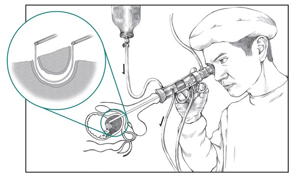 Ilustración de un médico realizando una resección transuretral de la próstata (TURP, por sus siglas en inglés). Una toma agrandada muestra una vista microscópica de un asa de alambre cortando tejido de la próstata.