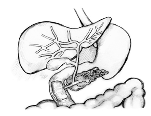 Dibujo del sistema biliar con el hígado, vías biliares (conductos biliares), el conducto biliar común, la vesícula biliar, el páncreas, la papila duodenal, el conducto pancreático principal y el duodeno