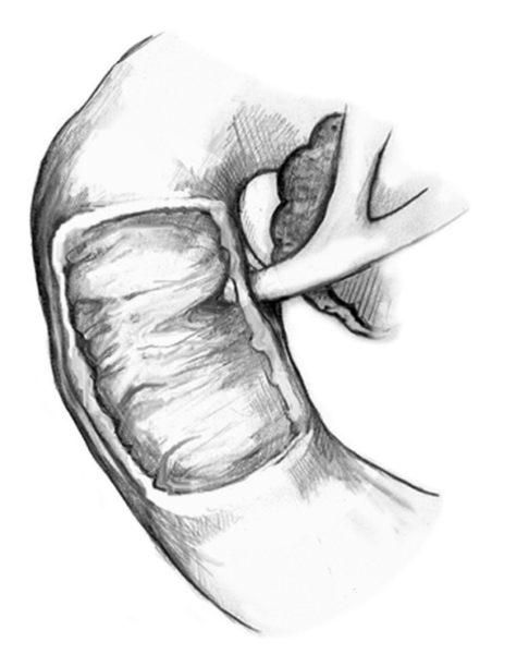 Dibujo del sistema biliar con la papila duodenal y el orificio papilar.