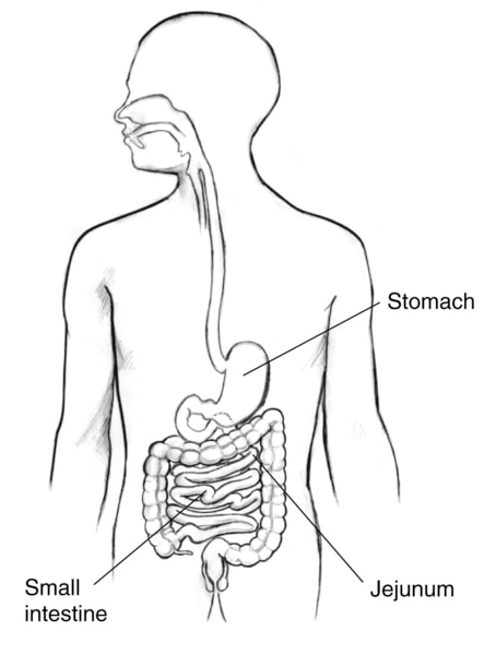 Drawing of the digestive tract with the stomach, small intestine, and jejunum labeled.