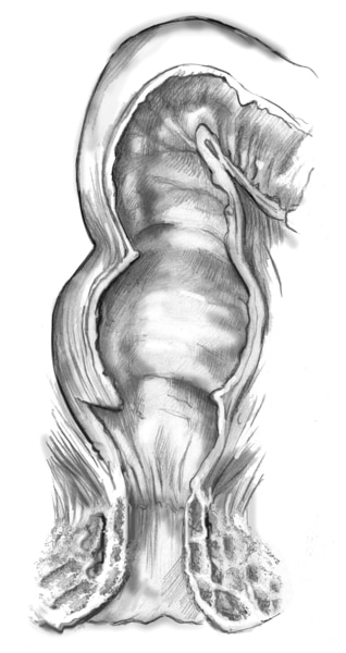 Dibujo de los músculos de esfínteres anales externo e interno con el esfínter interno, el esfínter externo, el recto y el ano.