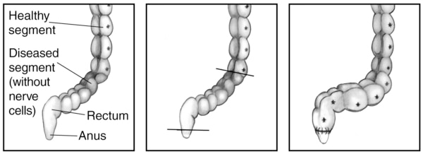 Drawing of part of the large intestine before and after a pull-through procedure. Labeled are the healthy segment and diseases segment, rectum and anus.
