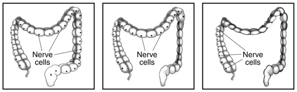 Drawing of a healthy large intestine. Nerve cells are labeled.