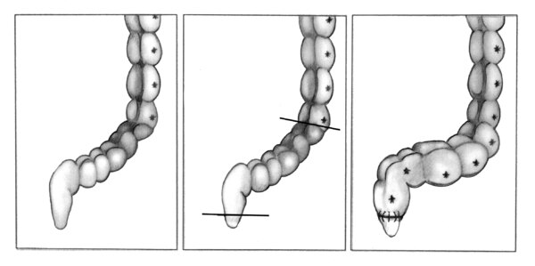Drawing of part of the large intestine before and after a pull-through procedure.