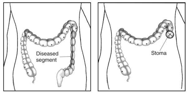 Drawing of the large intestine showing the diseased segment before and after ostomy surgery.