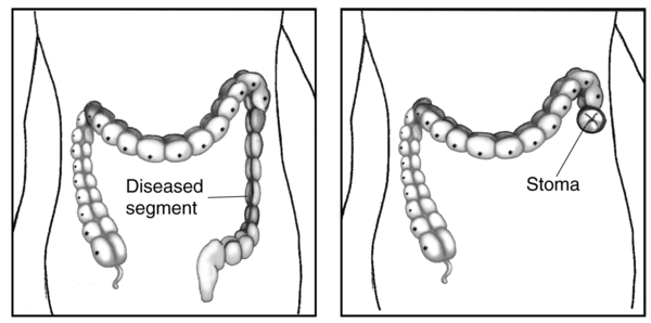 Drawing of the large intestine showing the diseased segment before and after ostomy surgery.