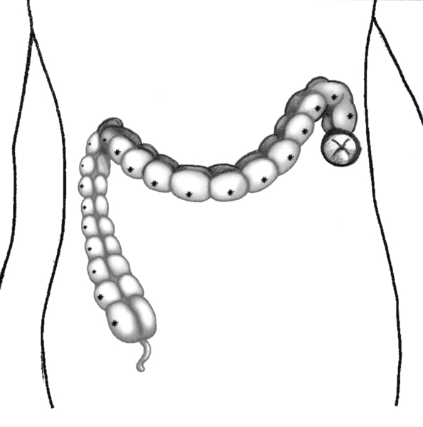 Drawing of the large intestine with the diseased segment removed and a stoma placed at the end.