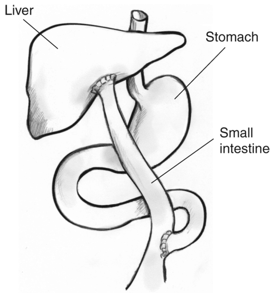 Diagram of the Kasai procedure with liver, stomach, and small intestine labeled.