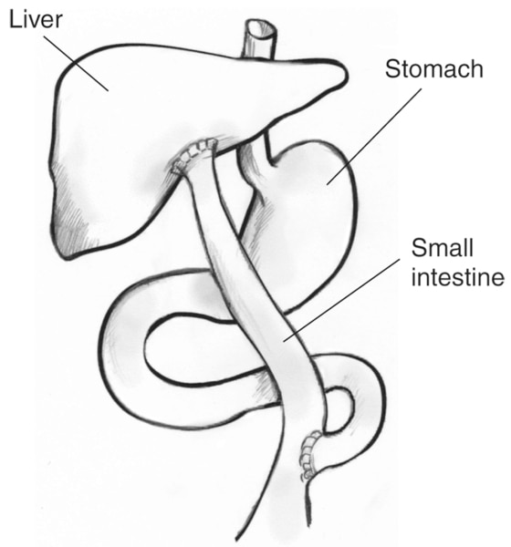 Diagram of the Kasai procedure with liver, stomach, and small intestine labeled.