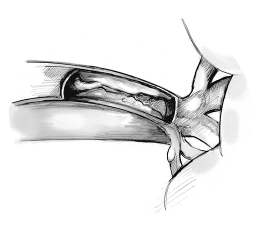 Drawing of the kidneys showing a magnified cross-section of the renal artery with plaque building up on the inner wall.