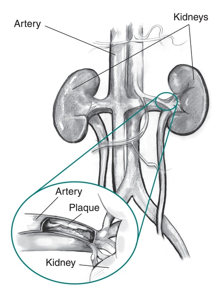 Drawing of the kidneys with an insert showing a magnified cross-section of the renal artery with plaque building up on the inner wall.