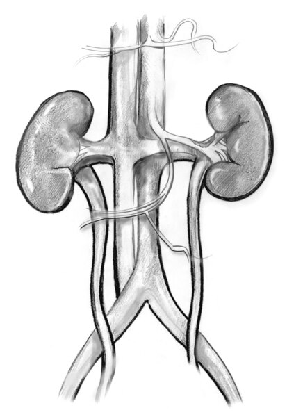 Drawing of the kidneys, in most cases of Renal Artery Stenosis, plaque builds up on the inner wall of one or both renal arteries .