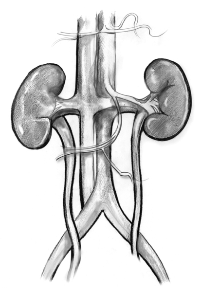 Drawing of the kidneys, in most cases of Renal Artery Stenosis, plaque builds up on the inner wall of one or both renal arteries .