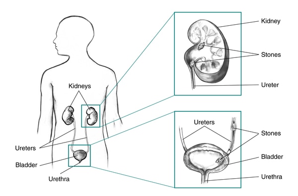 Drawing of the urinary tract with labels to the kidneys, bladder, ureters, and urethra. Insets show a cross section of the kidney with labels to the kidney, stones, and ureter and a cross section of the bladder with labels to the ureters, stones, bladder,