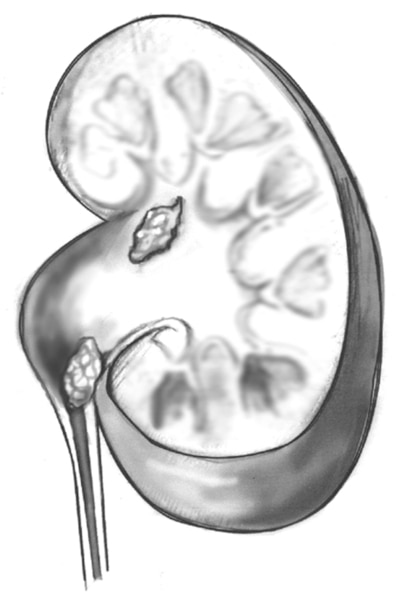 Drawing of cross section of the kidney with a stone.