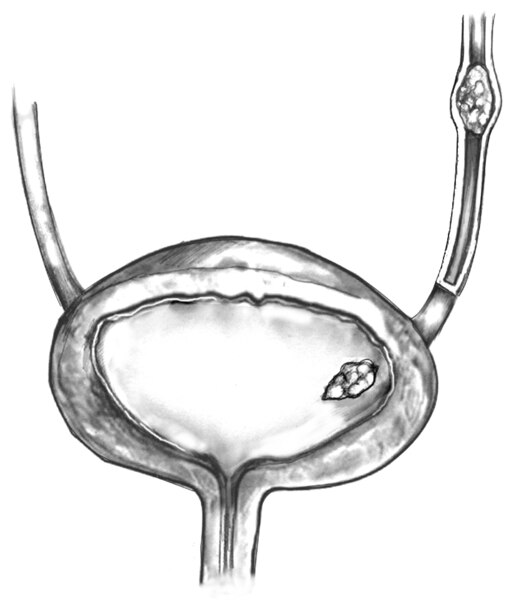 Drawing of cross section of the bladder with a stone.