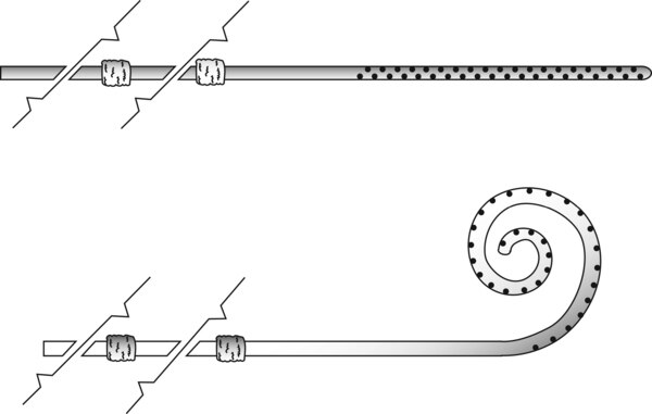 Dibujo de dos catéteres Tenckhoff que se usan en diálisis peritoneal.
