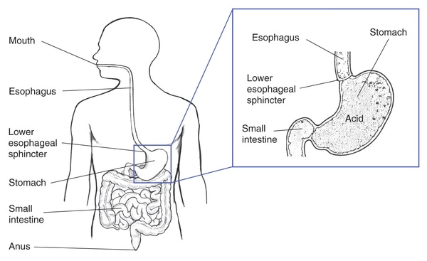 Drawing of the digestive tract within an outline of the top half of a human body. Inset shows a cross section of the stomach.