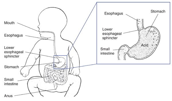 Drawing of the digestive tract within an outline of the top half of an infant’s body. Inset shows a cross section of the stomach.