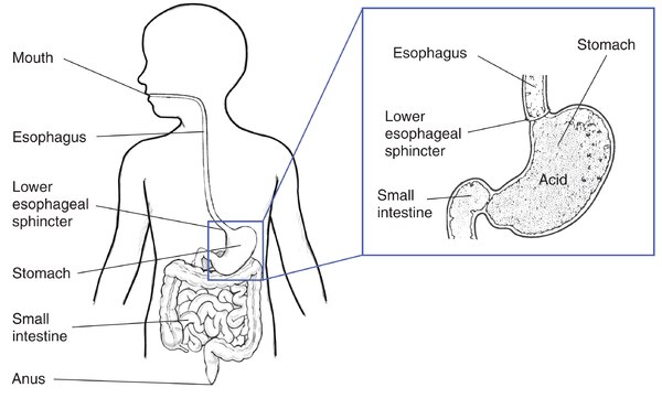 Drawing of the digestive tract within an outline of the top half of a child’s body. Inset shows a cross section of the stomach.